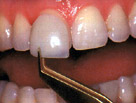 porcelain veneers