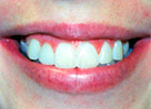 get your smile back with tooth implants